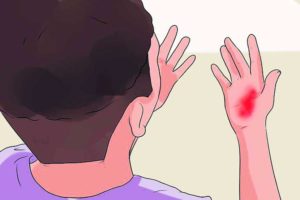 Remedies for Burns